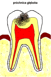 próchnica głęboka próchnica głęboka
