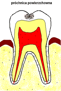 próchnica powierzchowna próchnica powierzchowna