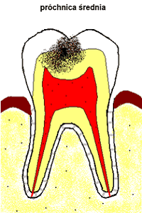 próchnica średnia próchnica średnia