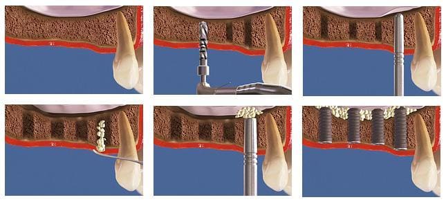 sinus lift zamknięty