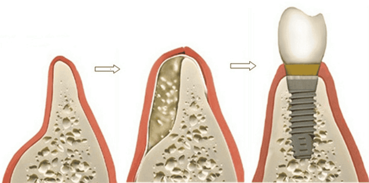 sterowana regeneracja kości