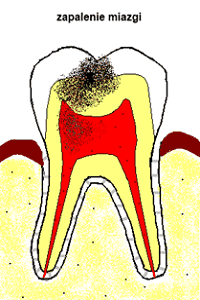 zapalenie miazgi zapalenie miazgi